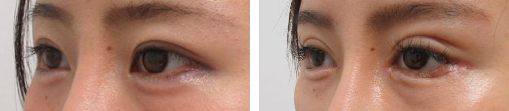 二重切開（全切開法）/目頭切開術/グラマラスライン（タレ目形成）の症例写真 施術前後 １ヵ月（化粧有り）