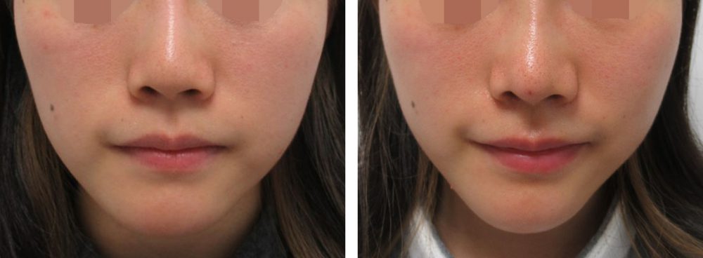 ヴィーナスノーズ（切らない鼻中隔延長術）/鼻尖4Dノーズ/隆鼻術（プロテーゼ・自家組織）の症例写真 施術前後 １週間