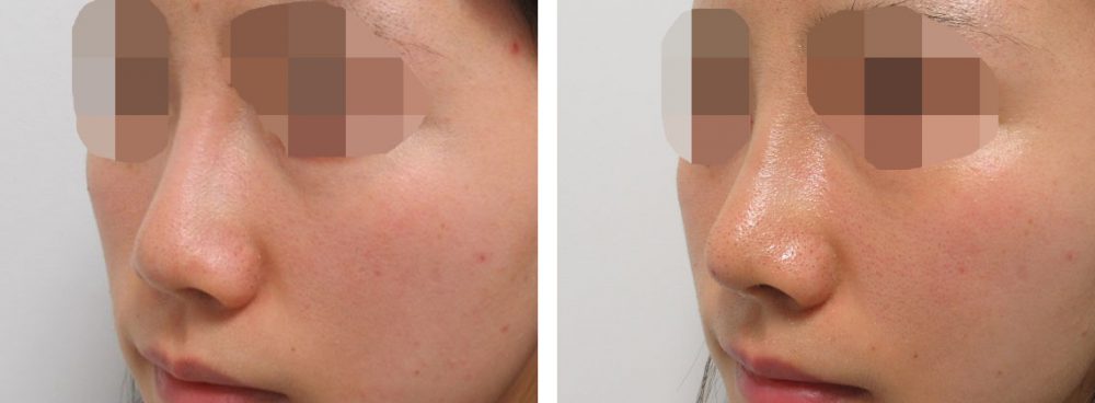 ヴィーナスノーズ（切らない鼻中隔延長術）/鼻尖4Dノーズ/隆鼻術（プロテーゼ・自家組織）の症例写真 施術前後 １週間