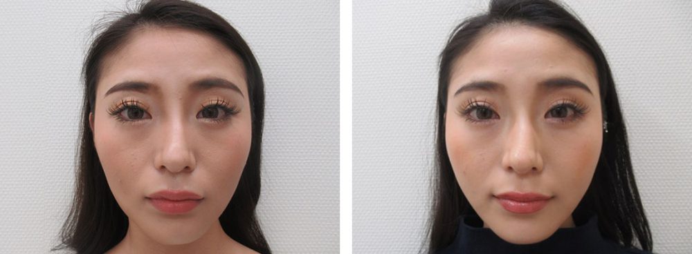 TAC式 ツヤ肌コラーゲンリフト®/ボトックス注射：その他の症例写真 施術前後 １ヵ月