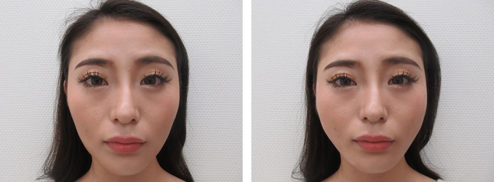 TAC式 ツヤ肌コラーゲンリフト®/ボトックス注射：その他の症例写真 施術前後 直後