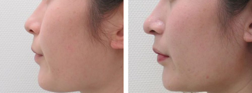 鼻尖４Dノーズで鼻に高さを出す