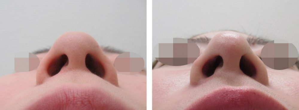 鼻尖4Dノーズの症例写真 施術前後 １ヵ月