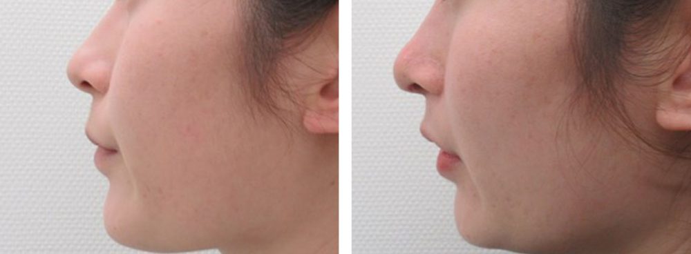 鼻尖4Dノーズの症例写真 施術前後 １週間