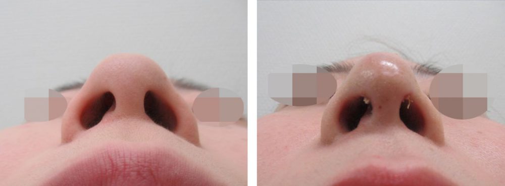 鼻尖4Dノーズの症例写真 施術前後 １週間
