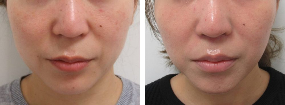 人中短縮術で鼻下の改善