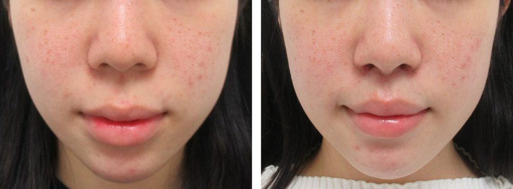 人中短縮術ですっきりした口元に