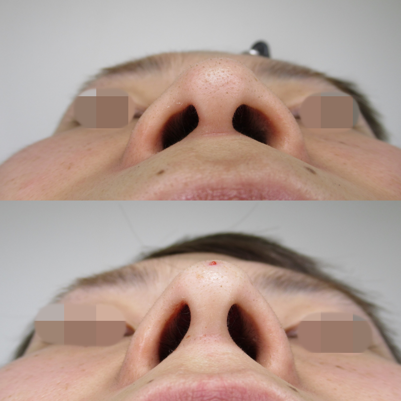 鼻中隔が短く、鼻翼外側が広がっているお鼻の対処法。