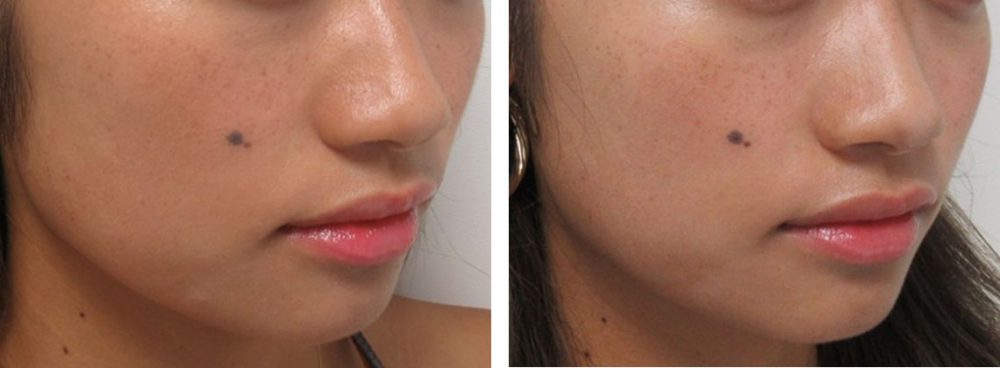 TAC式 ツヤ肌コラーゲンリフト®/ボトックス注射：その他の症例写真 施術前後 １ヵ月