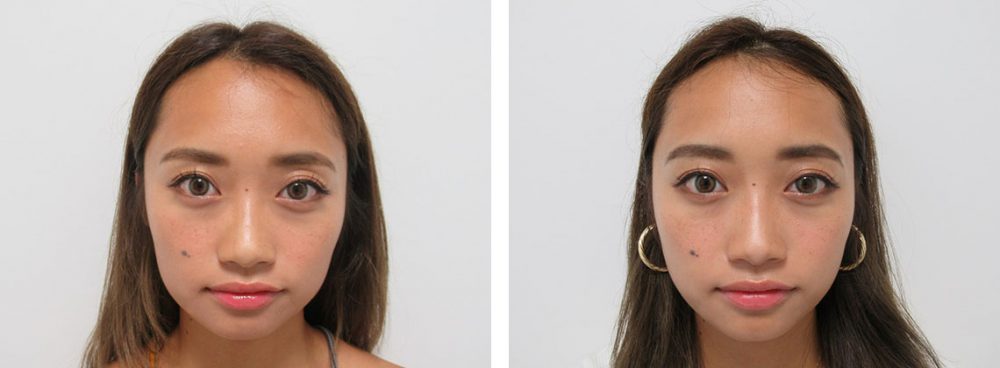 TAC式ツヤ肌コラーゲンリフトでたるみ予防