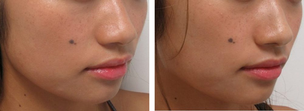TAC式 ツヤ肌コラーゲンリフト®/ボトックス注射：その他の症例写真 施術前後 ２週間