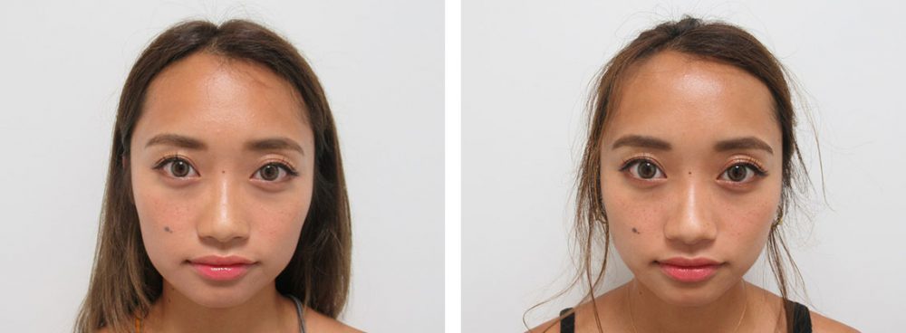 TAC式 ツヤ肌コラーゲンリフト®/ボトックス注射：その他の症例写真 施術前後 ２週間