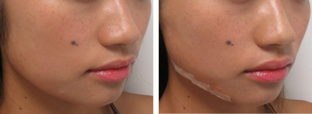 TAC式 ツヤ肌コラーゲンリフト®/ボトックス注射：その他の症例写真 施術前後 直後