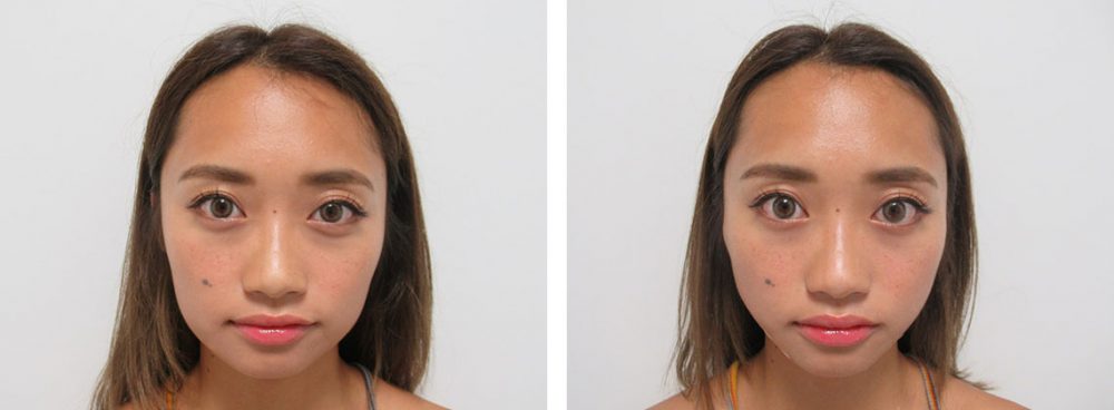 TAC式 ツヤ肌コラーゲンリフト®/ボトックス注射：その他の症例写真 施術前後 直後