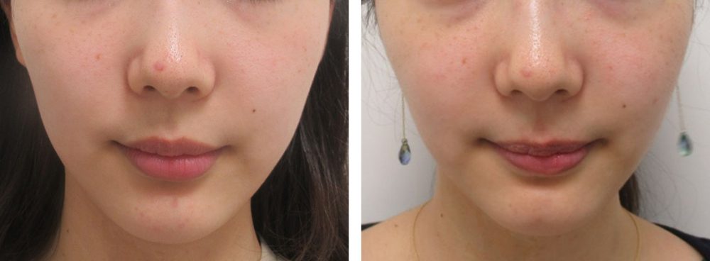 バッカルファット除去の施術のみです