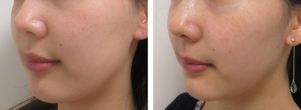 バッカルファット除去の症例写真 施術前後 １ヵ月