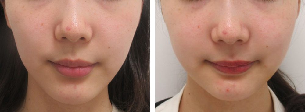 バッカルファット除去の症例写真 施術前後 １週間