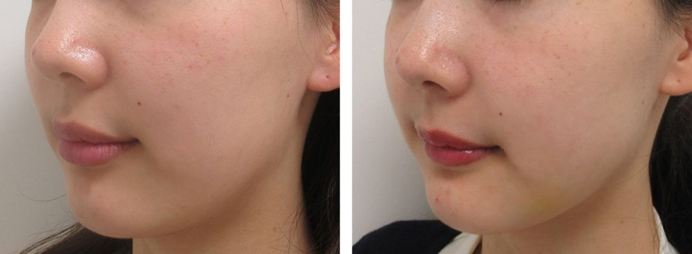 バッカルファット除去の症例写真 施術前後 １週間