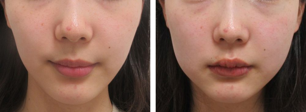 バッカルファット除去の症例写真 施術前後 直後