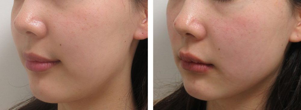 バッカルファット除去の症例写真 施術前後 直後