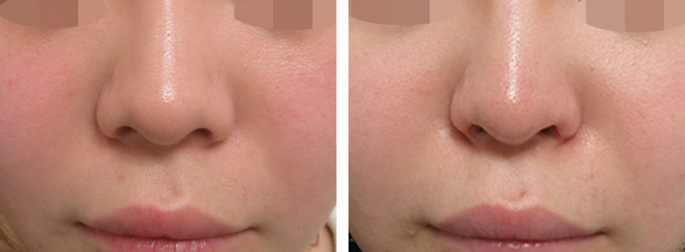 鼻孔縁挙上術/鼻尖4Dノーズ/鼻尖形成・鼻尖縮小の症例写真 施術前後 １ヵ月