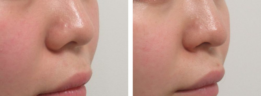 お鼻の複合手術でバランスのとれたお鼻に