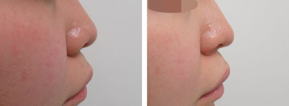 鼻孔縁挙上術/鼻尖4Dノーズ/鼻尖形成・鼻尖縮小の症例写真 施術前後 １ヵ月