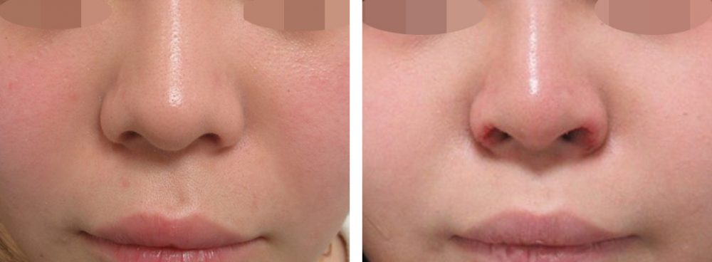 鼻孔縁挙上術/鼻尖4Dノーズ/鼻尖形成・鼻尖縮小の症例写真 施術前後 １週間