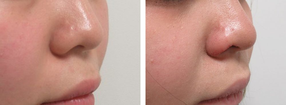 鼻孔縁挙上術/鼻尖4Dノーズ/鼻尖形成・鼻尖縮小の症例写真 施術前後 １週間