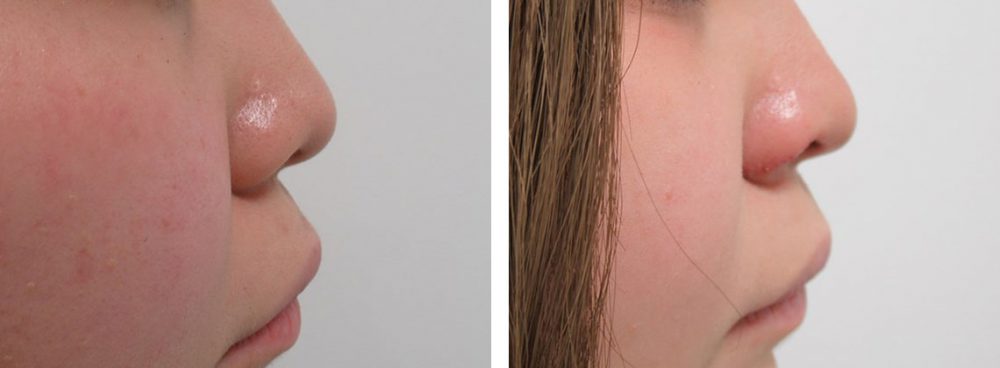 鼻孔縁挙上術/鼻尖4Dノーズ/鼻尖形成・鼻尖縮小の症例写真 施術前後 １週間