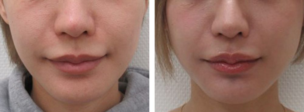 糸リフトで口角のたるみを改善