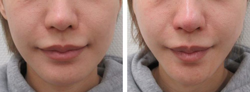 TAC式 ツヤ肌コラーゲンリフト®の症例写真 施術前後 直後