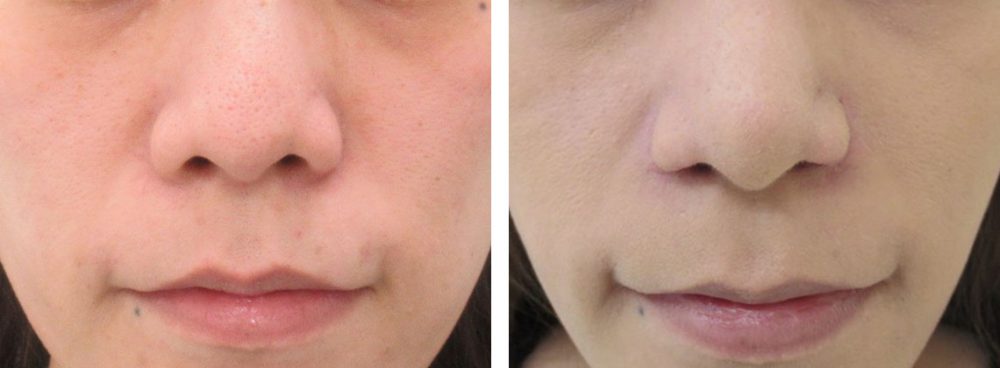 お鼻の穴を正面から目立たないように