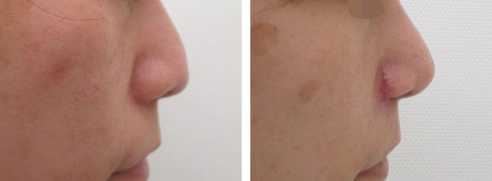 TAC式 鼻翼縮小術（小鼻縮小）/鼻翼挙上術/鼻孔縁挙上術の症例写真 施術前後 １ヵ月