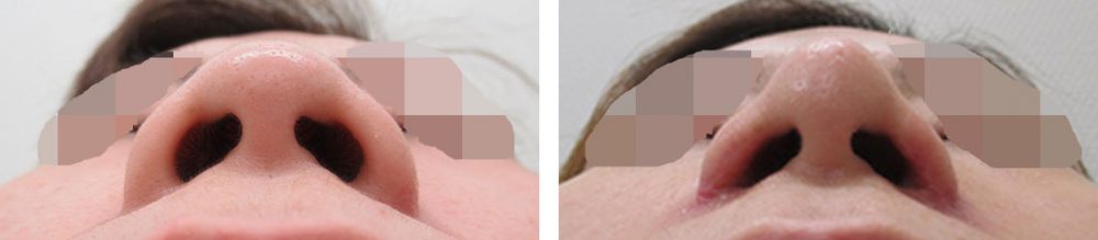 TAC式 鼻翼縮小術（小鼻縮小）/鼻翼挙上術/鼻孔縁挙上術の症例写真 施術前後 １ヵ月