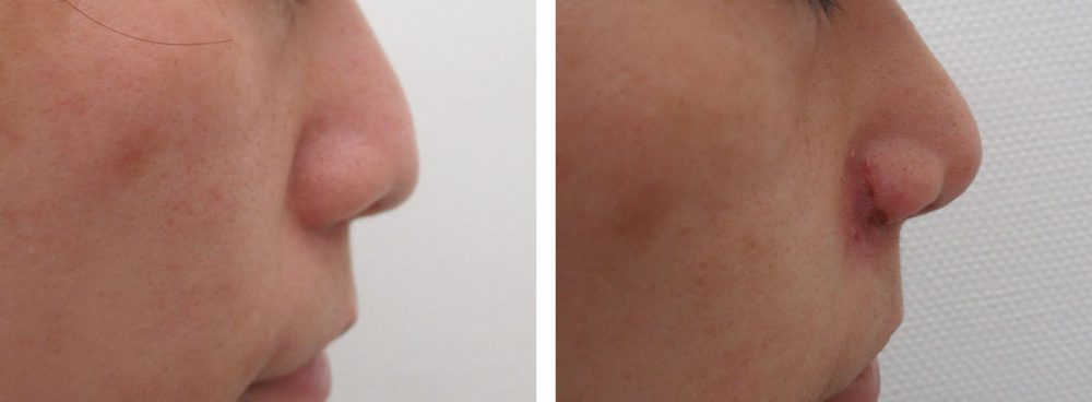 TAC式 鼻翼縮小術（小鼻縮小）/鼻翼挙上術/鼻孔縁挙上術の症例写真 施術前後 １週間
