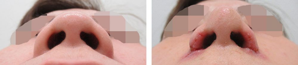 TAC式 鼻翼縮小術（小鼻縮小）/鼻翼挙上術/鼻孔縁挙上術の症例写真 施術前後 １週間