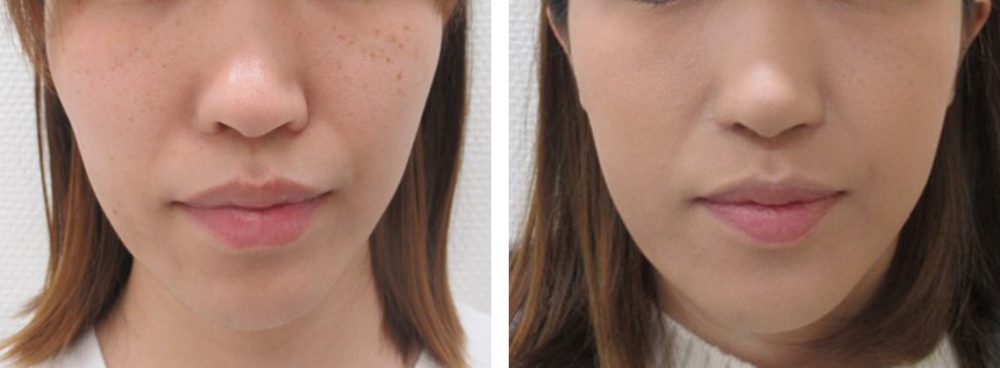 団子鼻がスマートなお鼻に変わりました