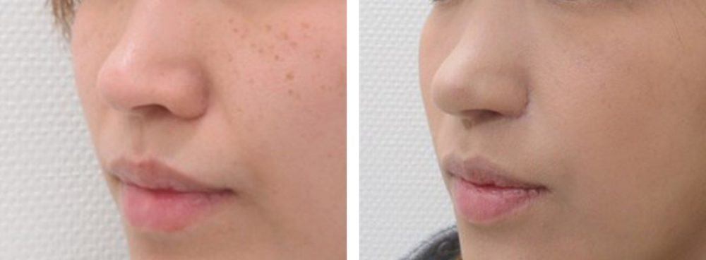 鼻孔縁挙上術/TAC式 鼻翼縮小術（小鼻縮小）/鼻尖4Dノーズの症例写真 施術前後 １ヵ月