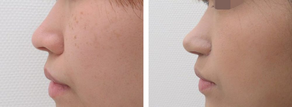 鼻孔縁挙上術/TAC式 鼻翼縮小術（小鼻縮小）/鼻尖4Dノーズの症例写真 施術前後 １ヵ月