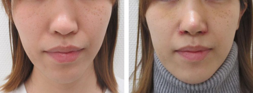 鼻孔縁挙上術/TAC式 鼻翼縮小術（小鼻縮小）/鼻尖4Dノーズの症例写真 施術前後 １週間