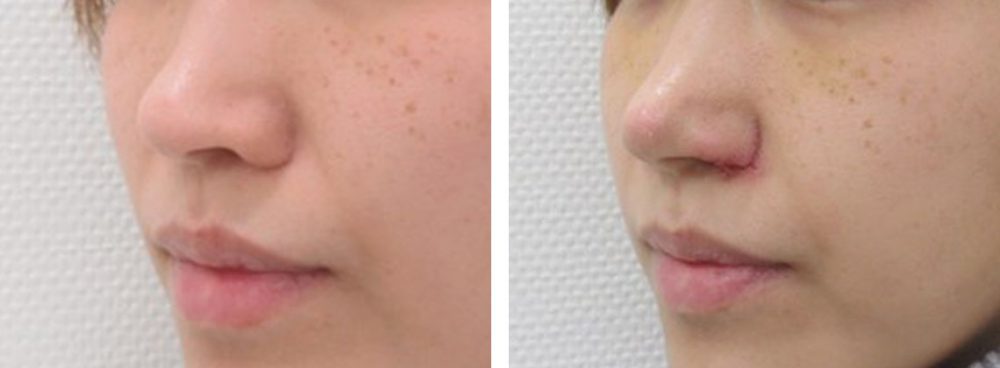 鼻孔縁挙上術/TAC式 鼻翼縮小術（小鼻縮小）/鼻尖4Dノーズの症例写真 施術前後 １週間