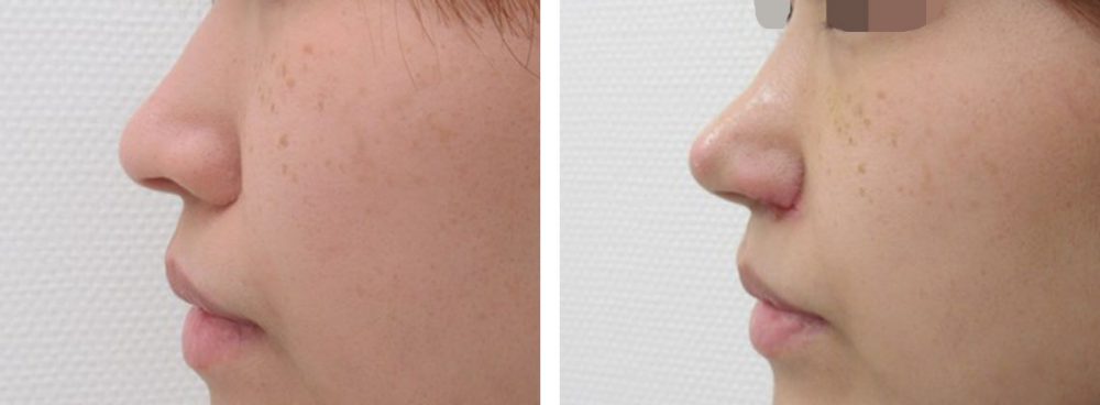 鼻孔縁挙上術/TAC式 鼻翼縮小術（小鼻縮小）/鼻尖4Dノーズの症例写真 施術前後 １週間