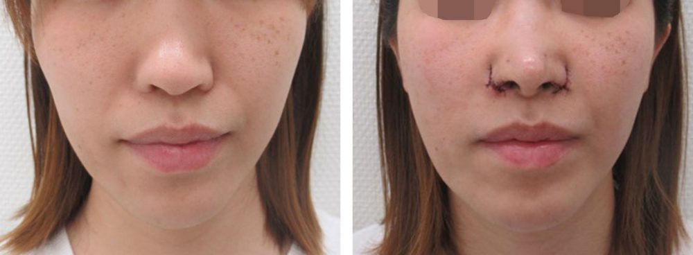 鼻孔縁挙上術/TAC式 鼻翼縮小術（小鼻縮小）/鼻尖4Dノーズの症例写真 施術前後 直後
