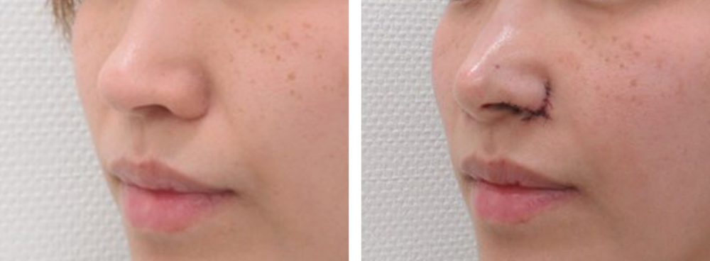 鼻孔縁挙上術/TAC式 鼻翼縮小術（小鼻縮小）/鼻尖4Dノーズの症例写真 施術前後 直後