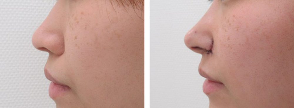 鼻孔縁挙上術/TAC式 鼻翼縮小術（小鼻縮小）/鼻尖4Dノーズの症例写真 施術前後 直後