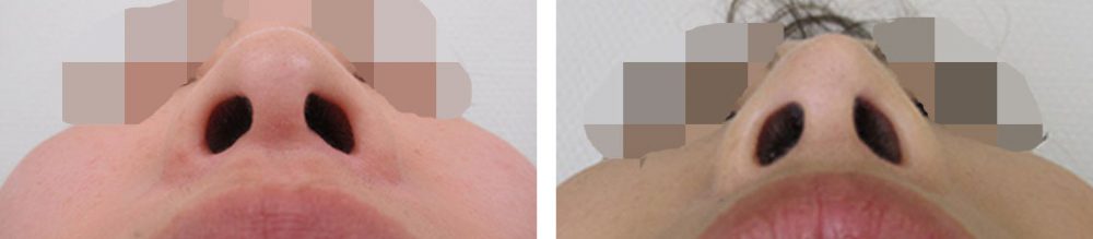 鼻尖形成と４Dノーズでシャープなお鼻に