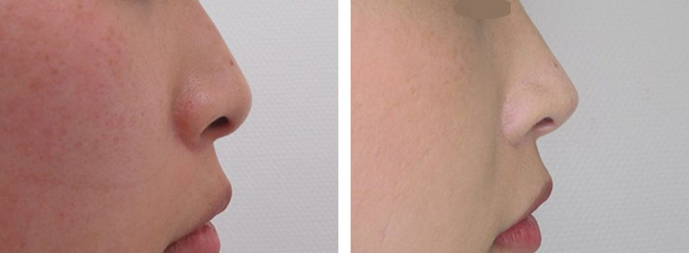 鼻尖4Dノーズ/鼻尖形成・鼻尖縮小の症例写真 施術前後 １ヵ月
