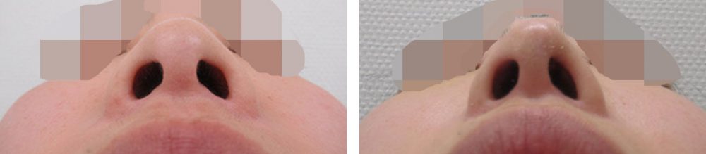 鼻尖4Dノーズ/鼻尖形成・鼻尖縮小の症例写真 施術前後 １週間
