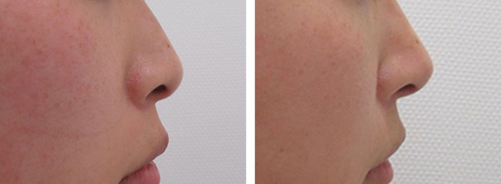 鼻尖4Dノーズ/鼻尖形成・鼻尖縮小の症例写真 施術前後 １週間